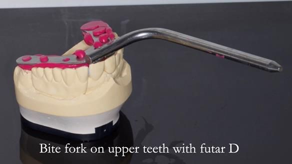 Newsletter 44 - extreme removable prosthodontics – engineering a super-strong and ultra-thin over denture