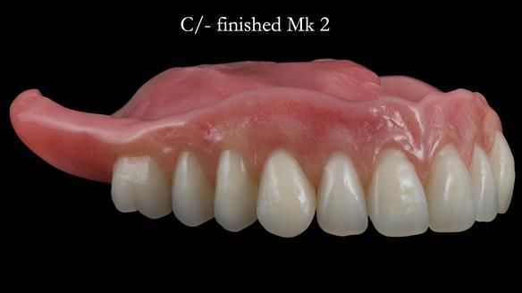 Newsletter 52 Managing Jo’s failing dentition with extractions and Mk 1/Mk 2 complete upper dentures and lower partial dentures FULL PROTOCOL
