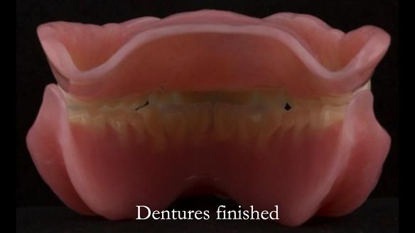 Newsletter 75: Marion’s case - Step-by-step complete denture workflow