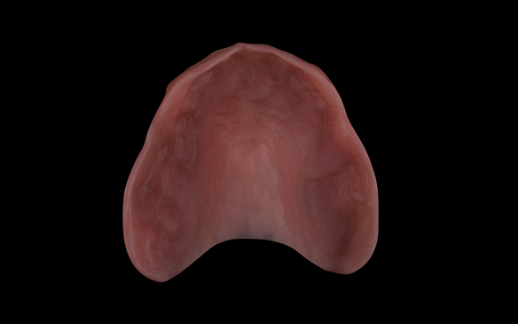 Figure 59 Dental laboratory relined intaglio surface using Pegasus Cold Cure acrylic - Schottlander