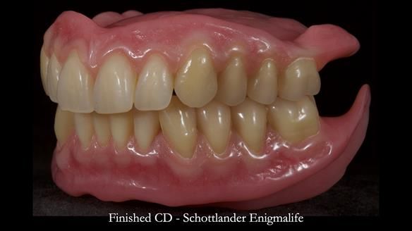 Newsletter 83: Sheila’s Complete Denture Success
