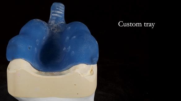 Newsletter 81 - Pam’s Story — how a partial denture changed her life (+ live walkthrough this Thursday)