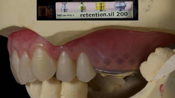 Finlay's Newsletter 58 Gasket upper partial denture for Zoe