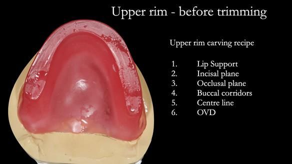 Solving Linda’s Failed “All on 4” implant bridges - full protocol Newsletter 42