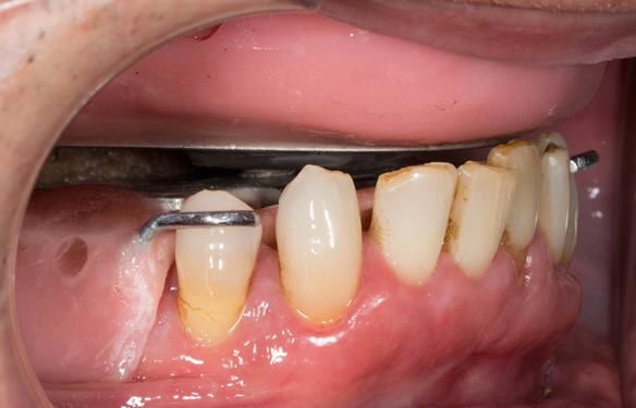 Figure 92 Visit 3 for Mk 2 fabrication. Inter-maxillary registration with central bearing apparatus in the mouth with the maxillary and mandibular parts "locked" together in CR by the pin in the hole