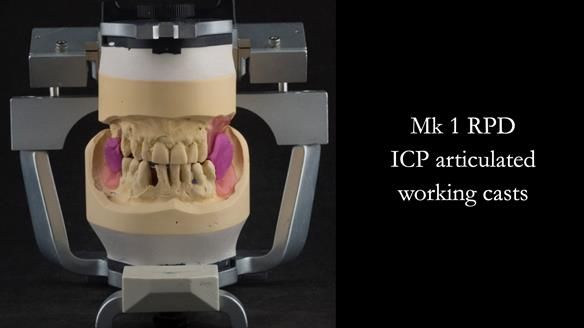 Finlay's Case Study Newsletter 40 - Immediate Mk 1 RPD to Definitive Mk 2 RPD - full protocol
