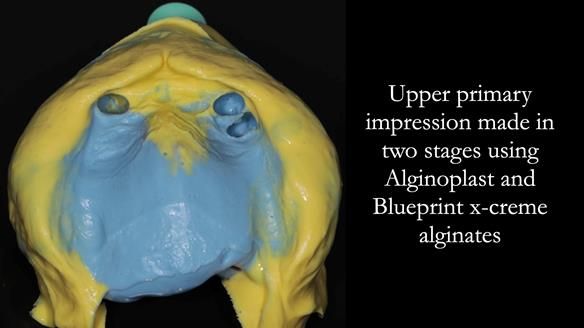 Finlay's Newsletter 59 Ultra hard partial dentures made for Gill