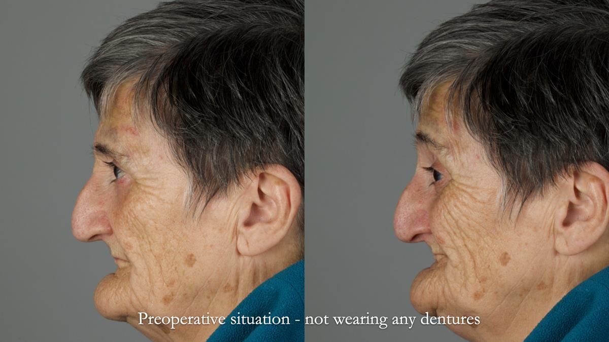 Newsletter 83: Sheila’s Complete Denture Success