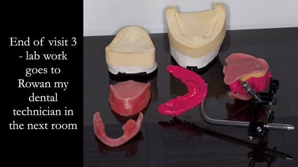 Replacing Madeline’s Complete denture FULL PROTOCOL