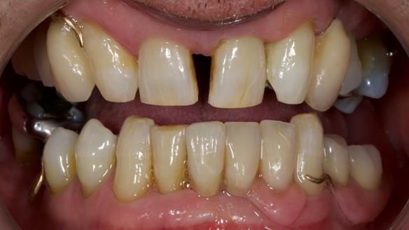 Newsletter 86 Peter the Architect — precision removable partial dentures case study