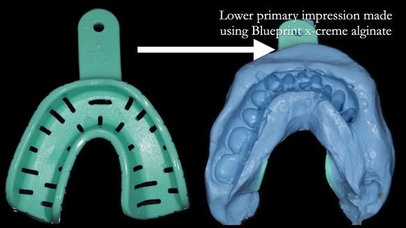 Finlay's Newsletter 60 Sylvia's upper Kennedy Class 2 Mod 1 metal based upper RPD