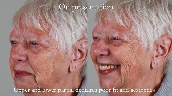 Finlay's Newsletter 59 Ultra hard partial dentures made for Gill
