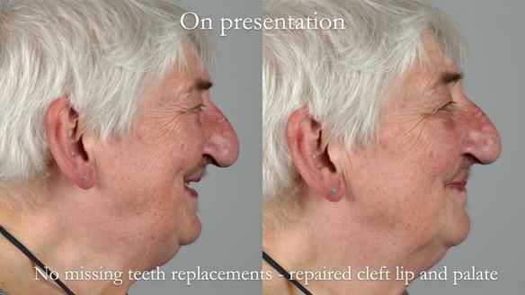 Newsletter 55 Provision of metal based partial dentures for Zephyrine with a repaired cleft lip and palate