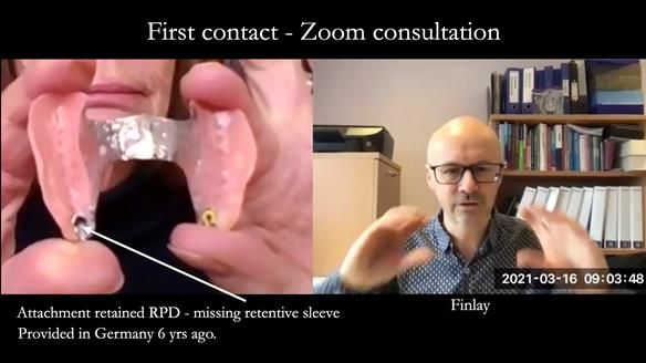 Newsletter 76: Jackie’s case – Telescopic overdenture & precision RPD (the tricky truth!)