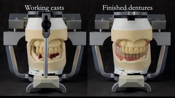 Newsletter 76: Jackie’s case – Telescopic overdenture & precision RPD (the tricky truth!)