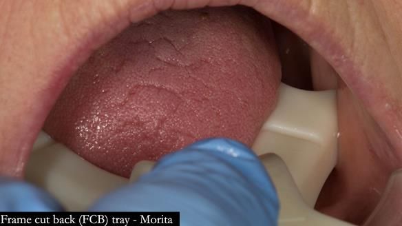 FCB tray - checking for size - large selected - lingual extension fits into retromylohyoid space