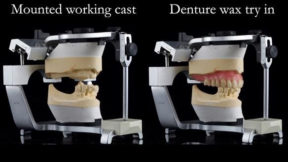 Newsletter 54 case presentation upper complete denture and lower Scandinavian designed hygienic partial denture for David