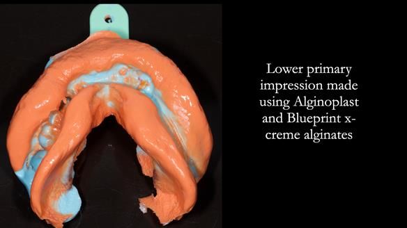 Newsletter 82 Mary - A complete upper and a one-tooth gasket denture