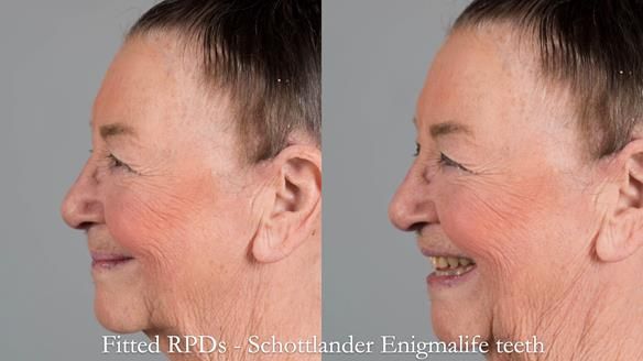 Finlay's Case Study Newsletter 40 - Immediate Mk 1 RPD to Definitive Mk 2 RPD - full protocol