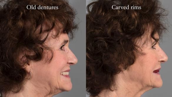 Newsletter 75: Marion’s case - Step-by-step complete denture workflow
