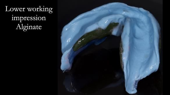 Newsletter 53 showing the making and fitting of ultra life-like dentures for Valena