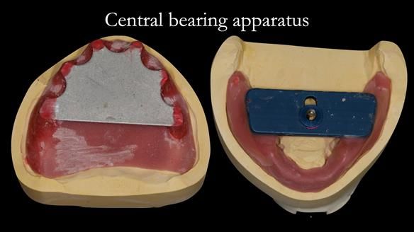 Managing poor implant positioning with complete dentures and Locator attachments - full protocol Newsletter 41
