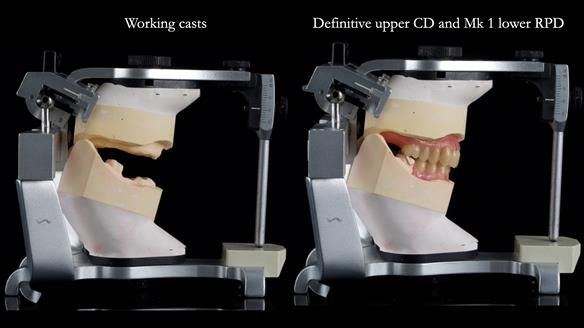 Newsletter 82 Mary - A complete upper and a one-tooth gasket denture