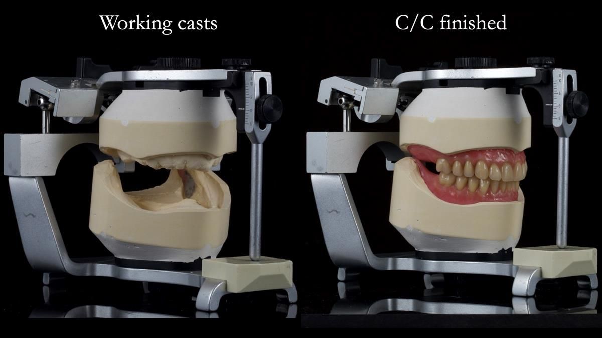 Fin’s Newsletter 88 — Complete dentures - full protocol… he rearranged his own teeth!