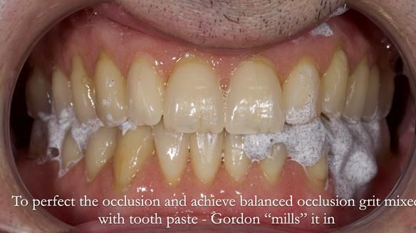Newsletter 80 - Gordon’s dentures: the one case in 1,000 where my technique failed