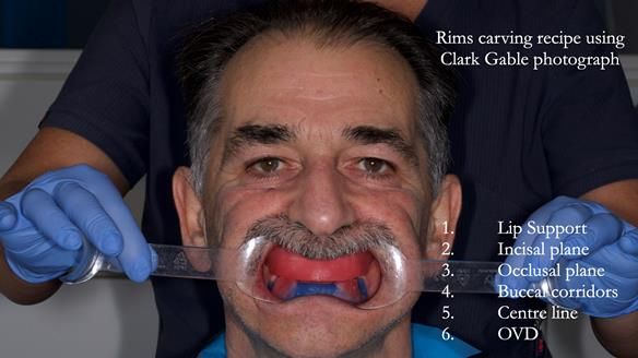 Newsletter 78: What do Clark Gable and a Locator® overdenture have in common?