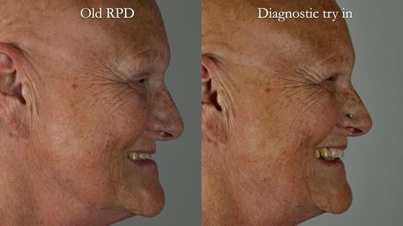 Newsletter 81 - Pam’s Story — how a partial denture changed her life (+ live walkthrough this Thursday)