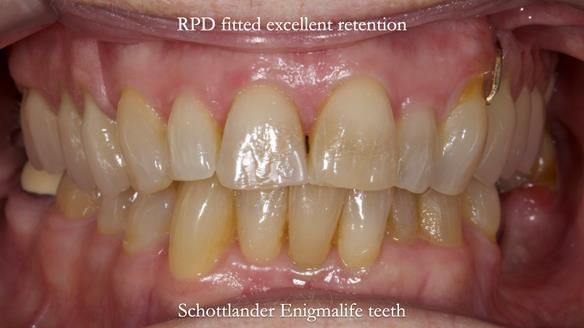 Finlay's Newsletter 60 Sylvia's upper Kennedy Class 2 Mod 1 metal based upper RPD