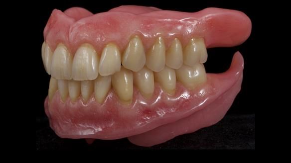 Newsletter 80 - Gordon’s dentures: the one case in 1,000 where my technique failed