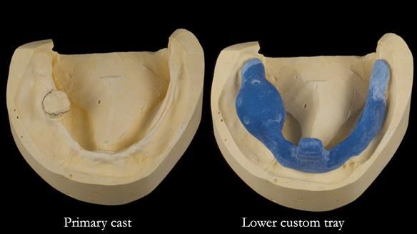 Newsletter 82 Mary - A complete upper and a one-tooth gasket denture