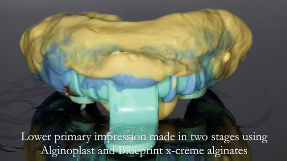 Newsletter 55 Provision of metal based partial dentures for Zephyrine with a repaired cleft lip and palate