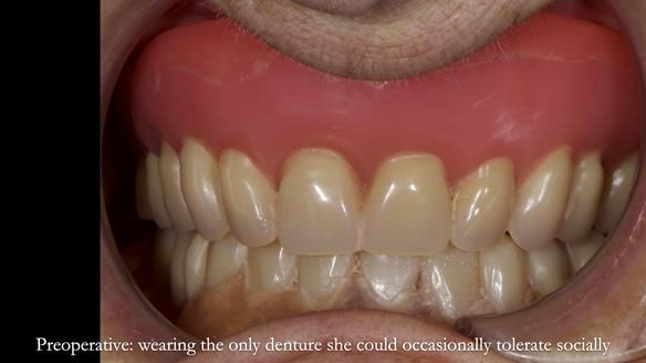 Newsletter 83: Sheila’s Complete Denture Success