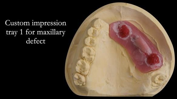 Upper metal base partial denture/occlusal stabilisation splint/obturator - full protocol