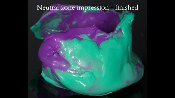 Newsletter 83: Sheila’s Complete Denture Success