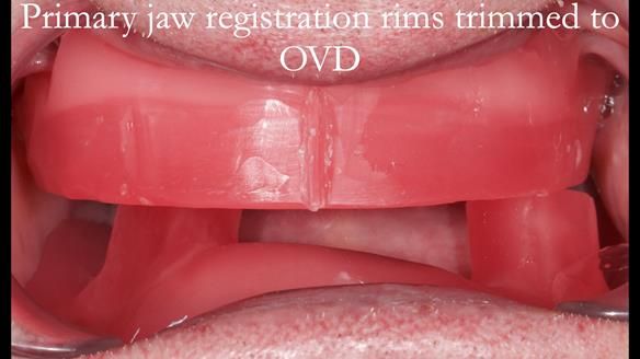 Complete denture Class II div 2 deep overbite Newsletter 39