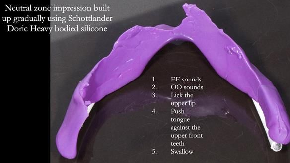 Newsletter 83: Sheila’s Complete Denture Success