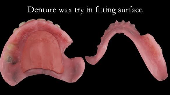 Newsletter 52 Managing Jo’s failing dentition with extractions and Mk 1/Mk 2 complete upper dentures and lower partial dentures FULL PROTOCOL