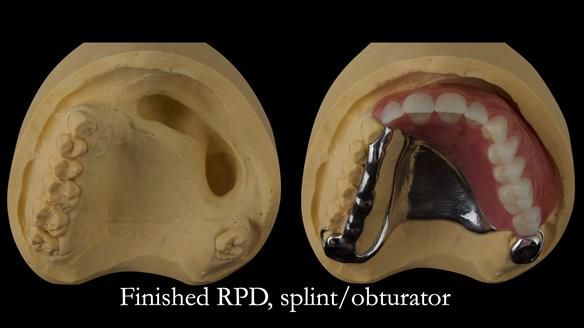 Upper metal base partial denture/occlusal stabilisation splint/obturator - full protocol