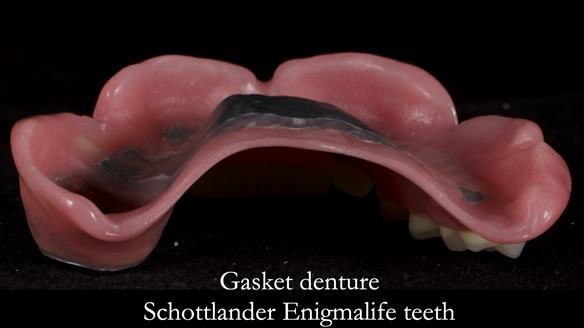 Finlay's Newsletter 59 Ultra hard partial dentures made for Gill
