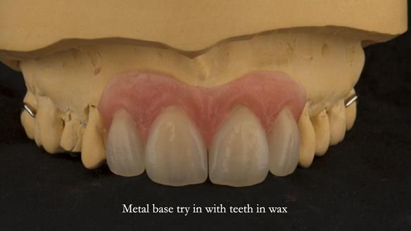 Finlay's Newsletter 63 Case study provision of metal based Scandinavian RPD - functional 10 years on