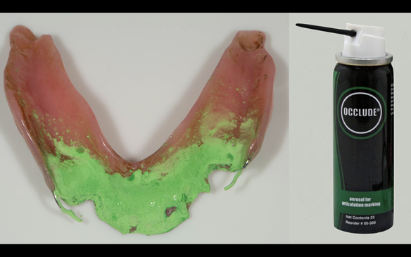 Figure 69 Mk 1 immediate lower partial denture requires adjustment to seat properly over the rest seats using Occlude spray