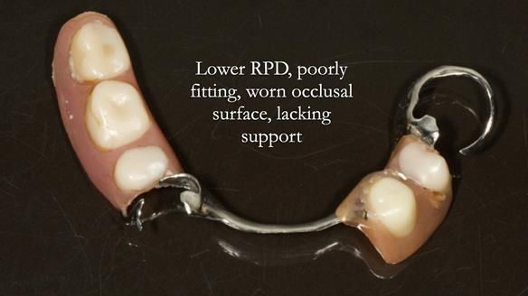 Eileen's transformation with upper and lower RPDs of Scandinavian hygienic design FULL PROTOCOL