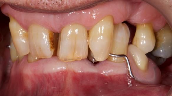 Newsletter 86 Peter the Architect — precision removable partial dentures case study