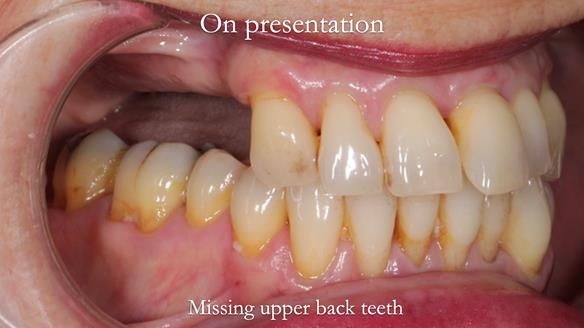 Newsletter 56 showing the making and fitting of a bilateral free end saddle upper removable partial denture (RPD) for patient with pemphigus