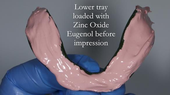 Finlay's Newsletter 62 provision of extractions and metal based complete dentures for Rafique