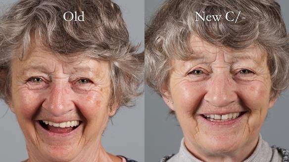 Solving Linda’s Failed “All on 4” implant bridges - full protocol Newsletter 42